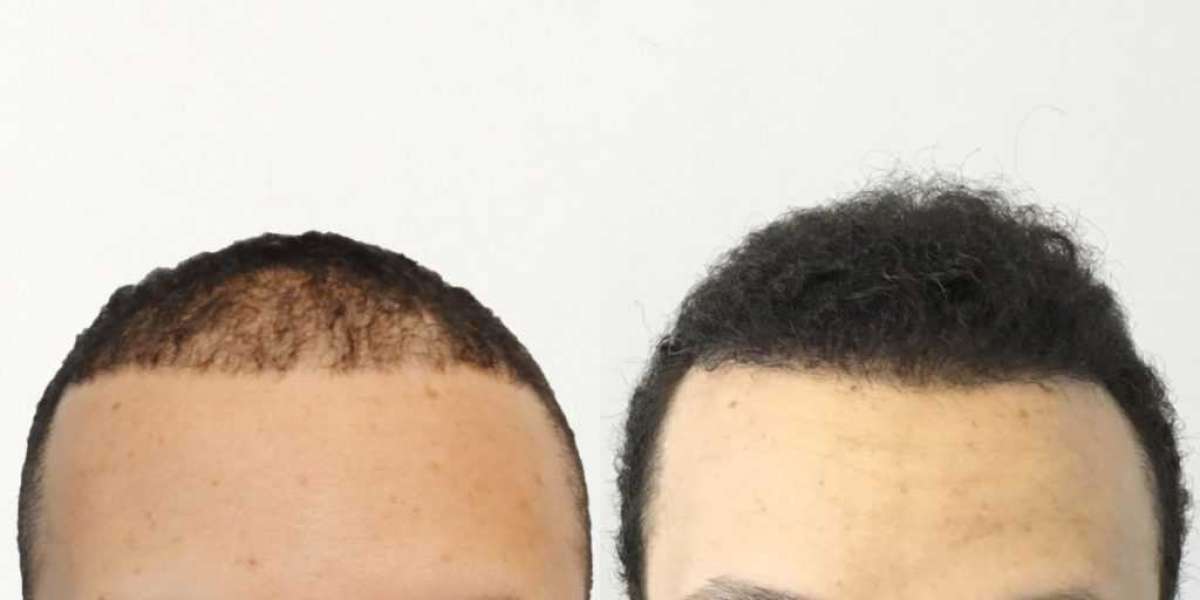 Hair Transplant Before and After