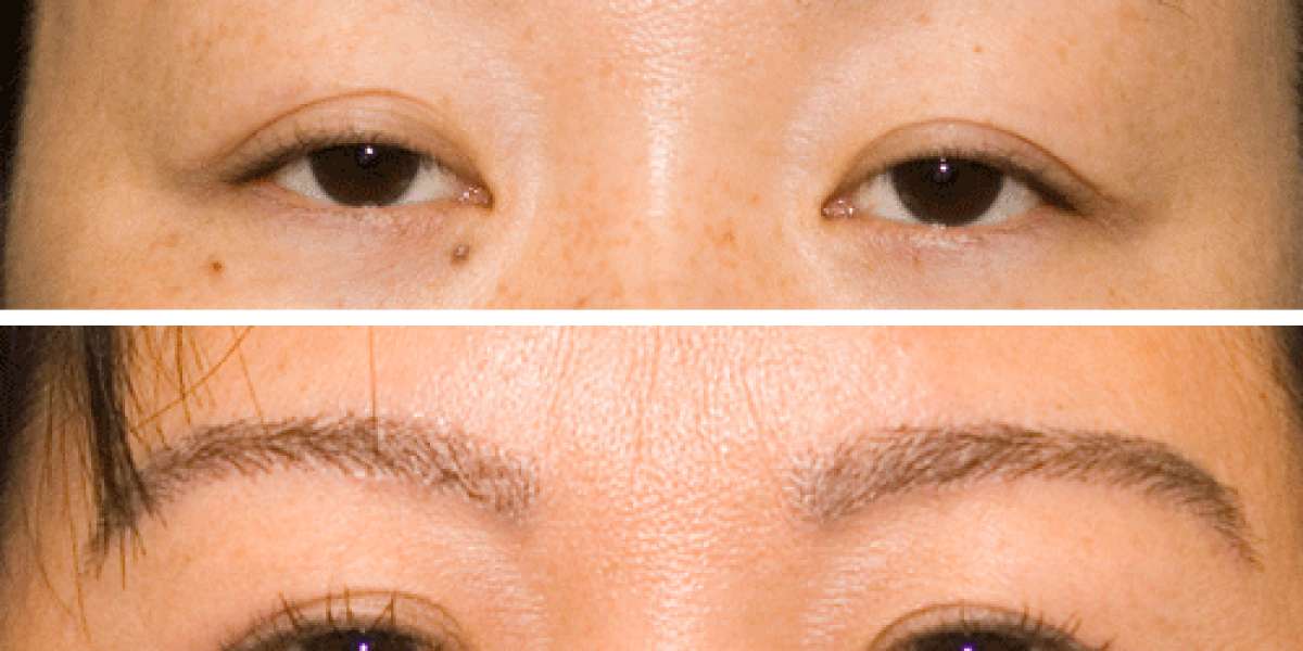 Eyebrows Restoration