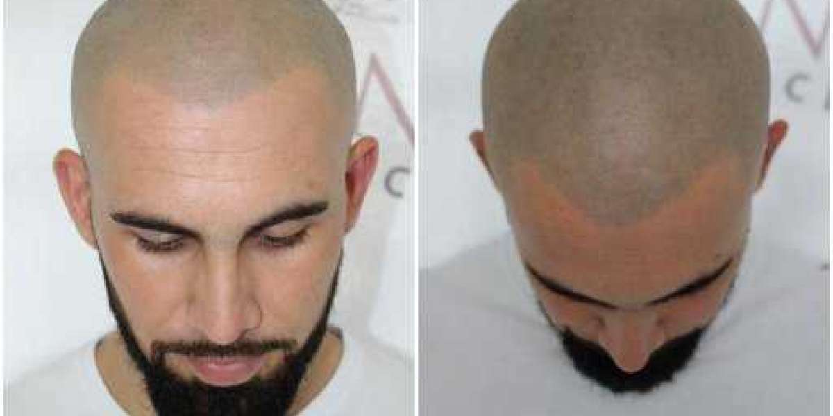 Scalp micropigmentation cost