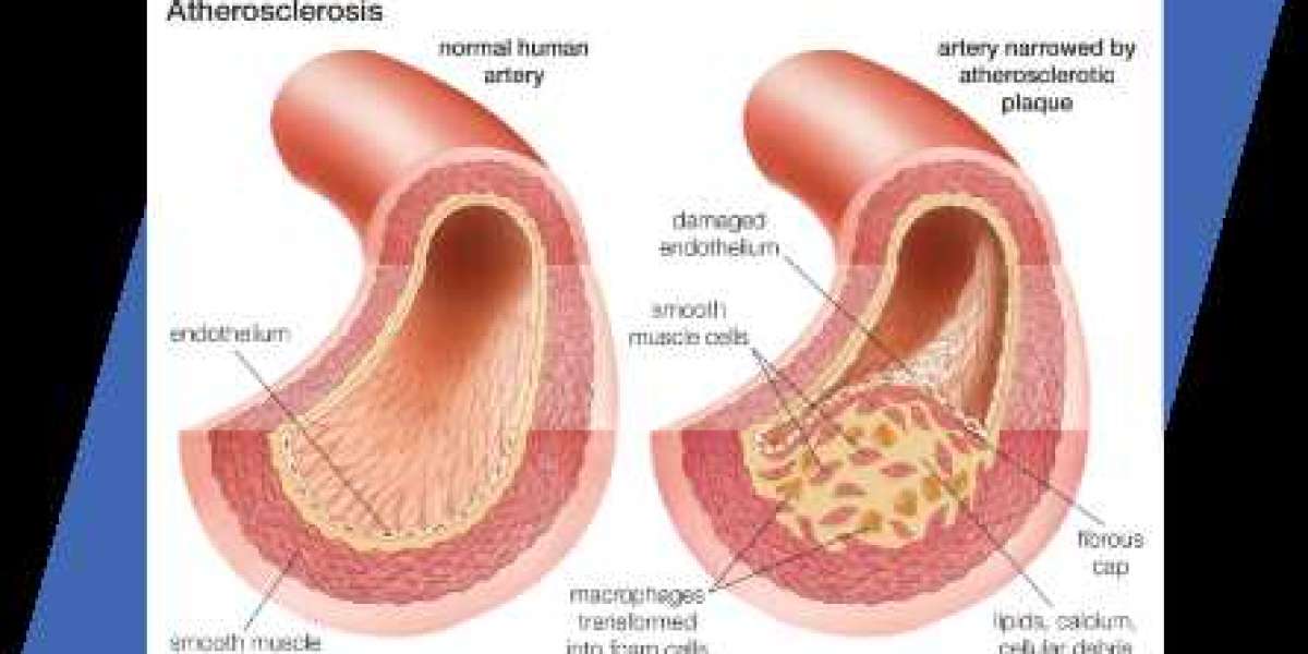 Anticoagulation