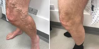 6 secret reasons to take the best private varicose vein treatment - Usd to Inr