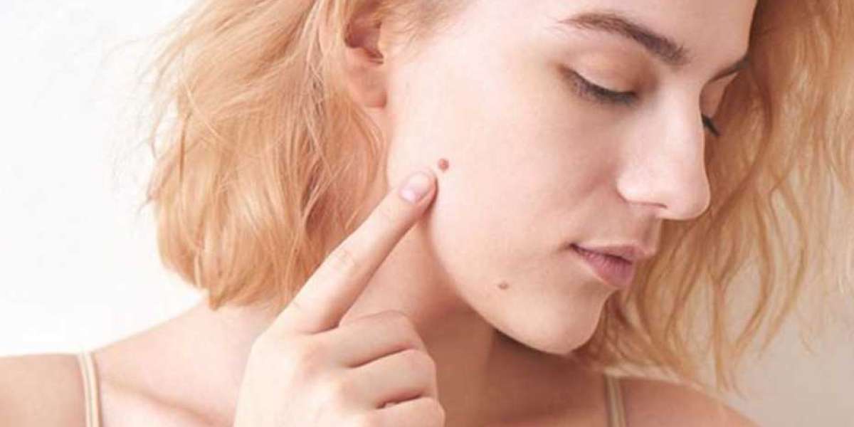 Coneflower Skin Tag Removal (Pros and Cons) Is It Scam Or Trusted?