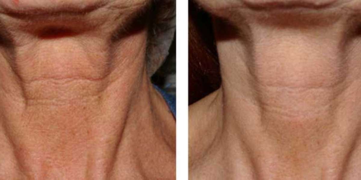 Microneedling on Neck