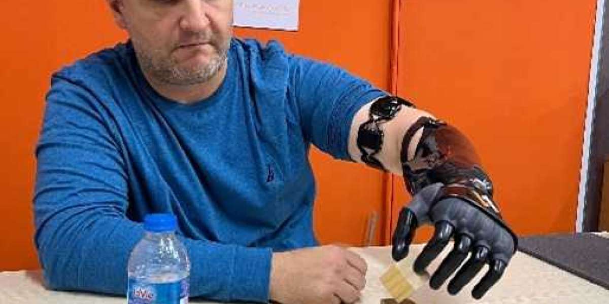 Upper Limb Prosthetics: Enhancing Mobility and Quality of Life