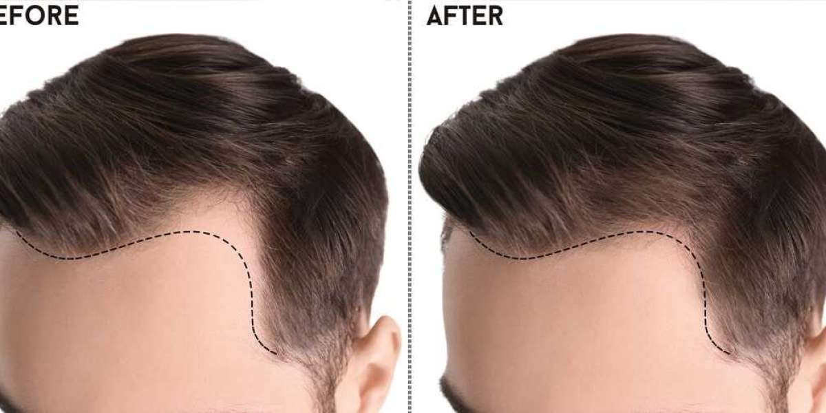 Redefining Beauty: The Art and Science of Hair Transplantation in Pakistan