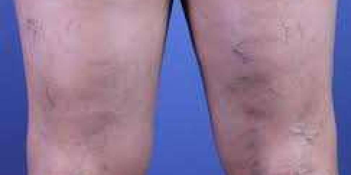 Sclerotherapy in Torrance, CA: The Effective Treatment for Spider and Varicose Veins