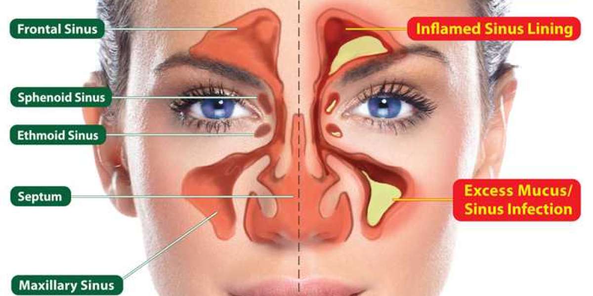 SINUSITIS & SINUS SURGERY