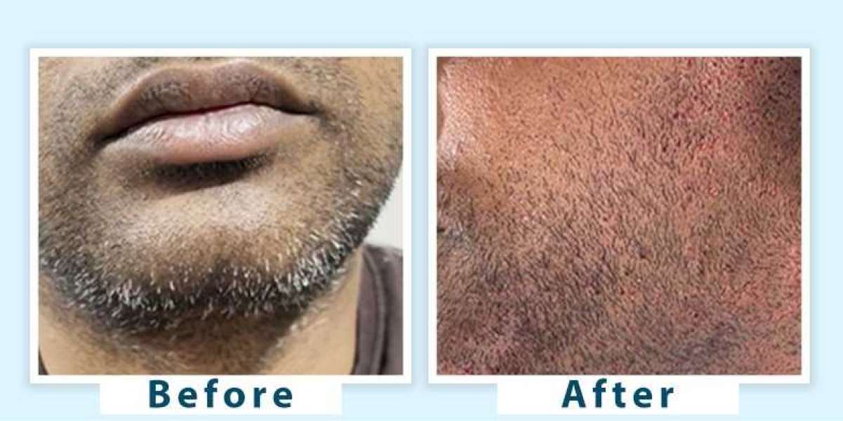 How to Prevent Beard Greying Tips, Treatments, and Lifestyle Changes