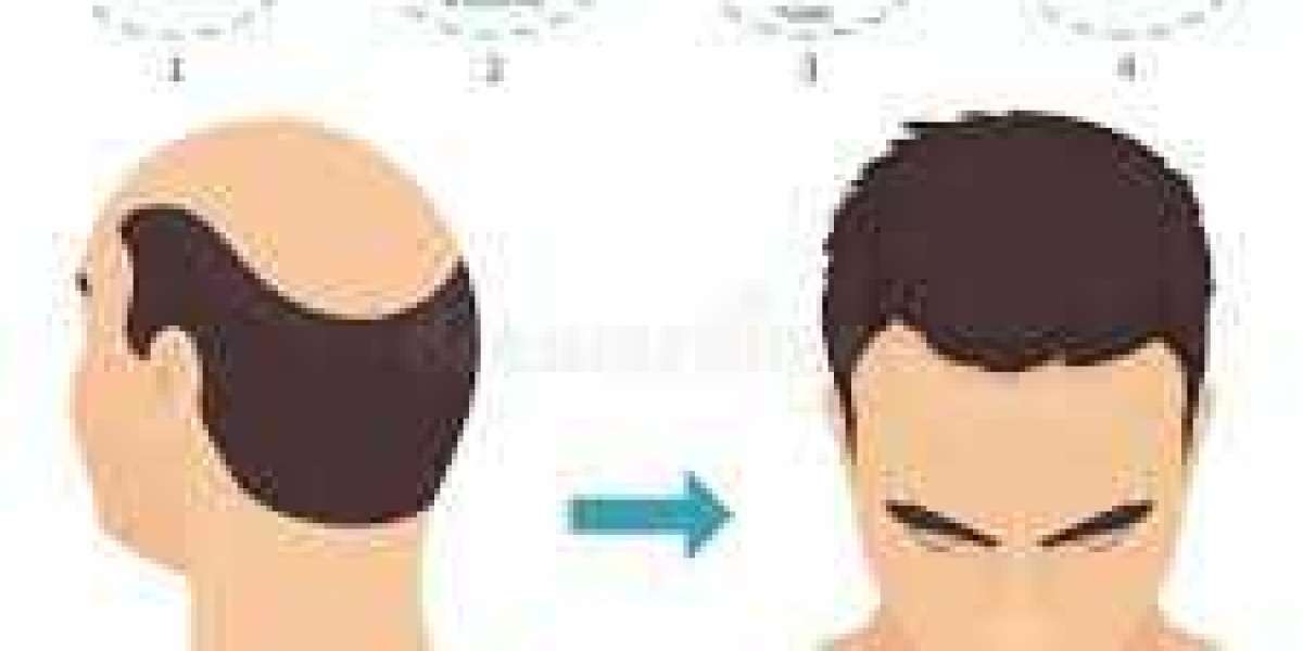 Hair Transplantation in USA