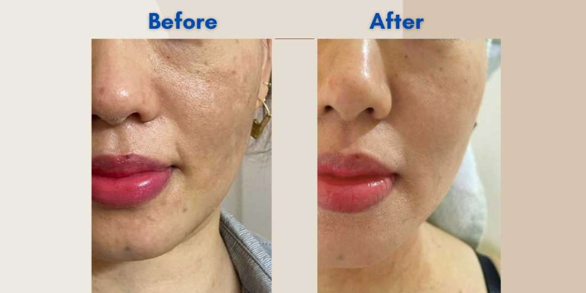 Best Korean Skin Treatment in Bangalore