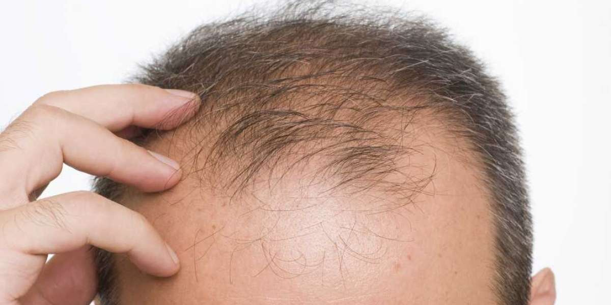 Does the success of a hair transplant depend on the donor area?