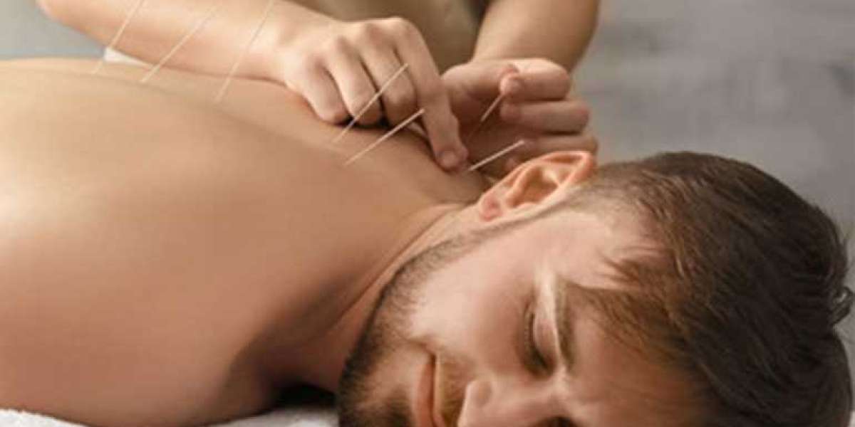 Discover the Healing Power of Acupuncture in St. Petersburg