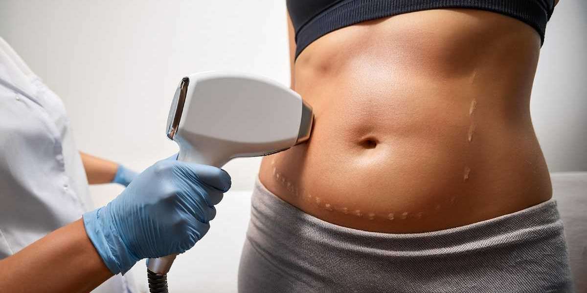 How To Get The Best Stretch Mark Treatment In London?