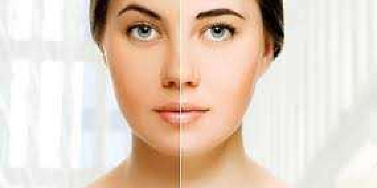 Skin Whitening Treatment in Dubai: Is It Right for You?