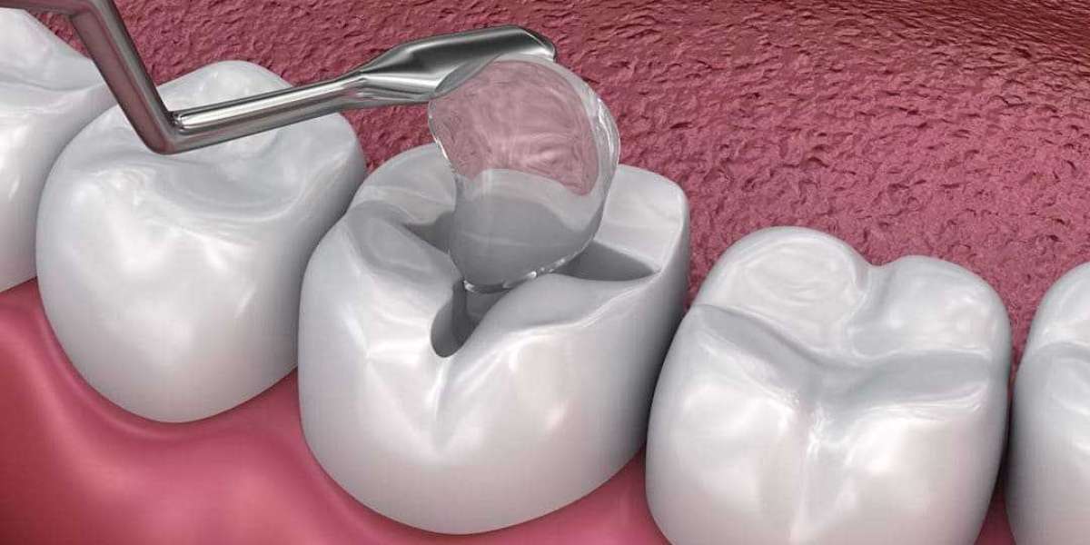 Is Tooth Filling in Dubai the Best Solution for Cavities?