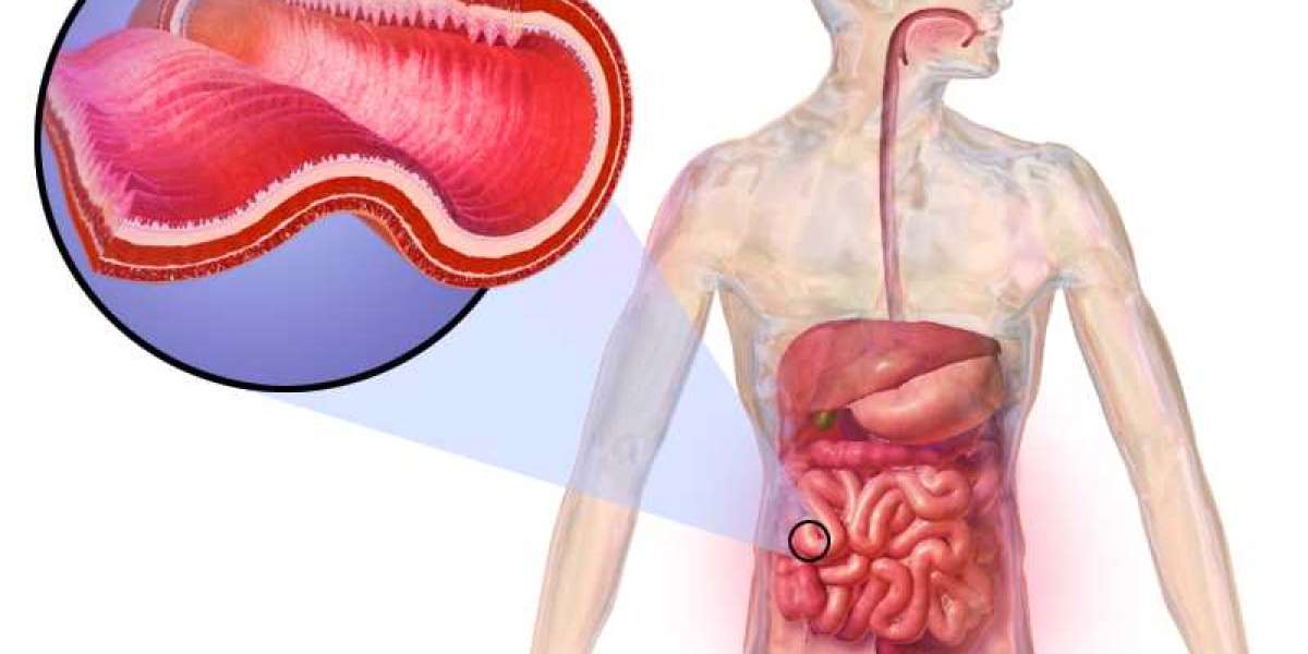 REMICADE in Focus: Clinical Trials, Efficacy, and Patient Outcomes in Crohn’s Disease