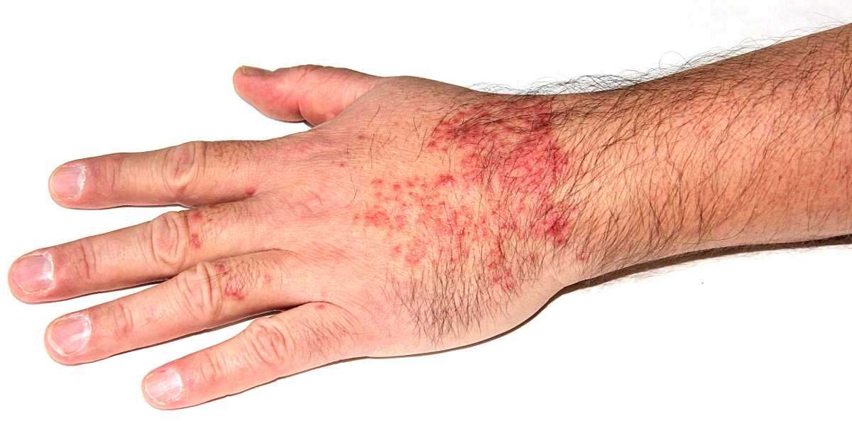 OPZELURA and Atopic Dermatitis: Clinical Breakthroughs & Market Insights