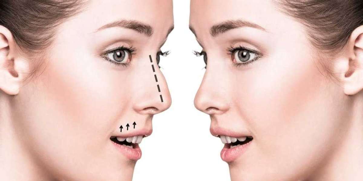 Are Nose Fillers in Dubai the Perfect Non-Surgical Solution for You?