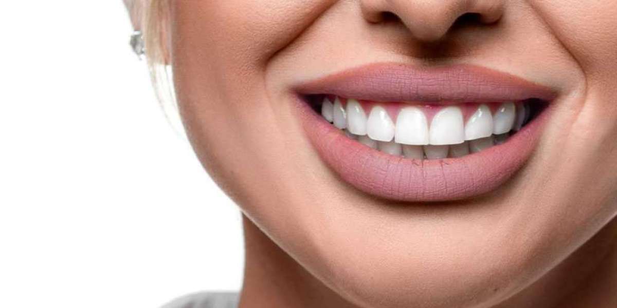 Is Hollywood Smile Dental Clinic the Key to Your Perfect Smile?