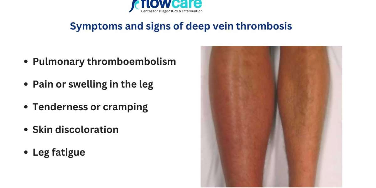 Recognizing DVT Symptoms: Early Signs and When to Seek Help