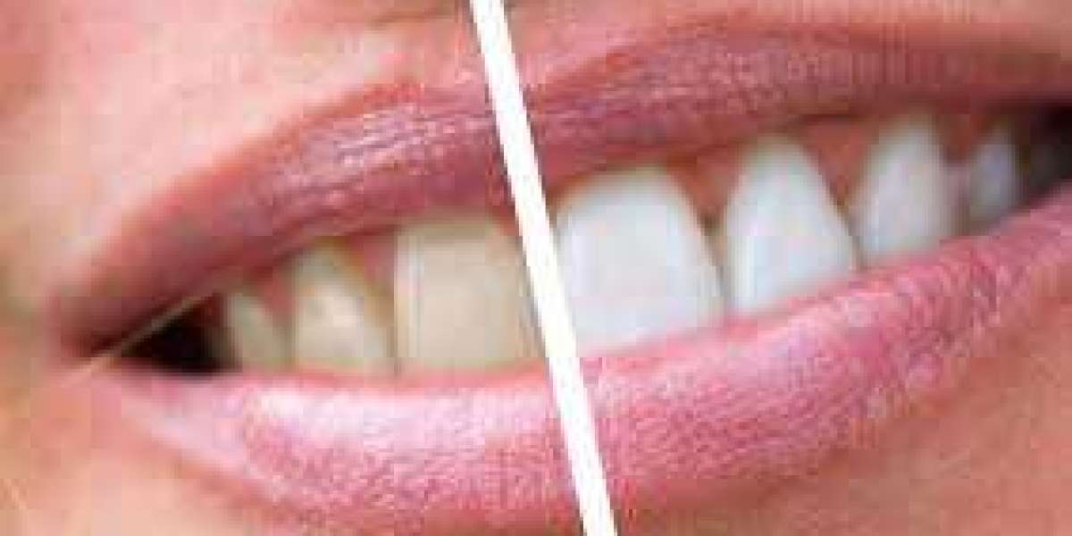 Where to Find the Best Teeth Whitening in Dubai?