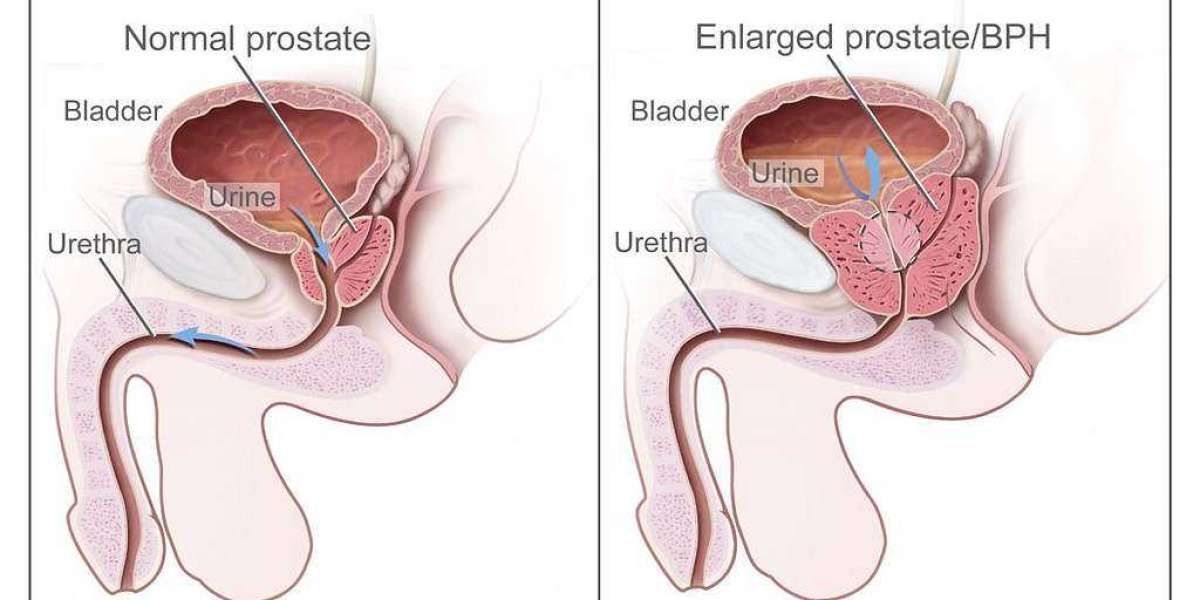 The ARAMIS Trial Legacy: How Nubeqa Redefined Prostate Cancer Care