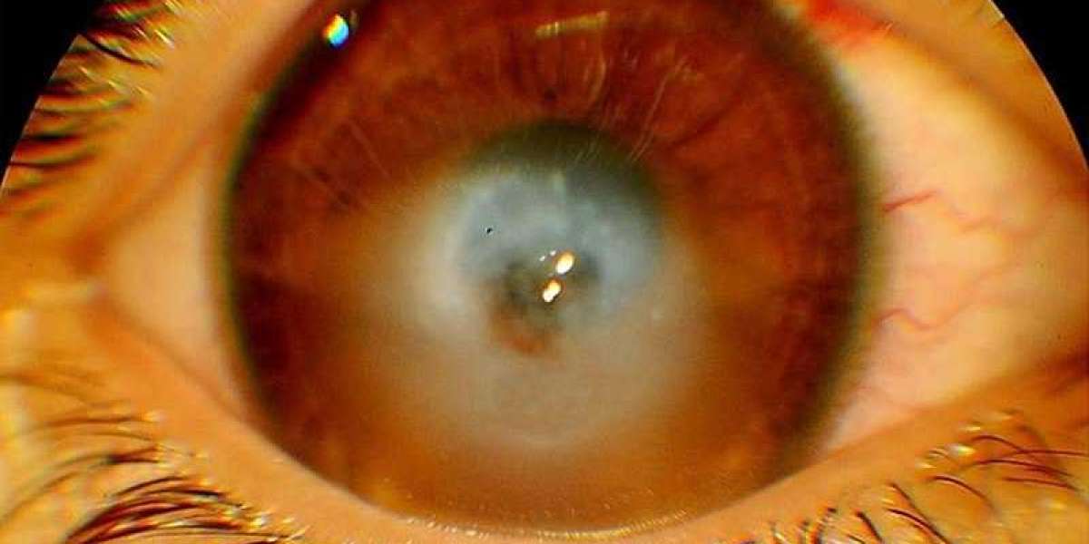 A New Era in Corneal Edema Management: Promising Therapies and Market Expansion