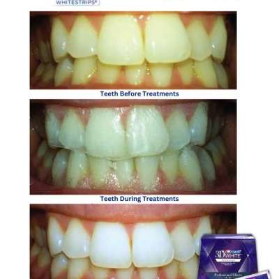 Crest White Strips – Brighten Your Smile with The White Smiles Profile Picture