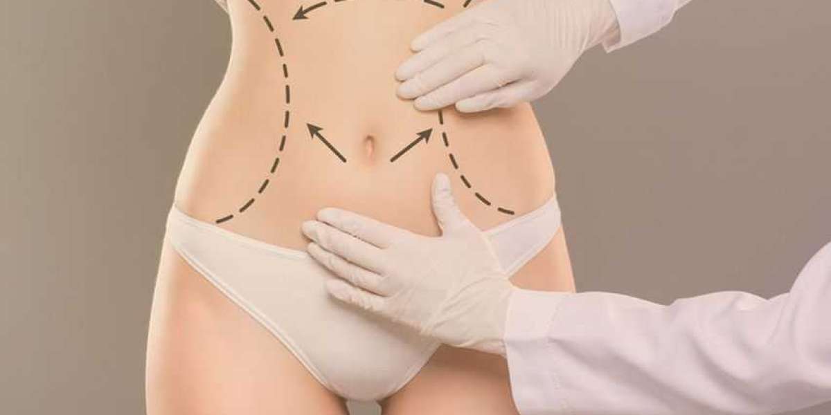 Tummy Tuck Surgery in Dubai - Achieve a Sculpted Abdomen with Expert Care