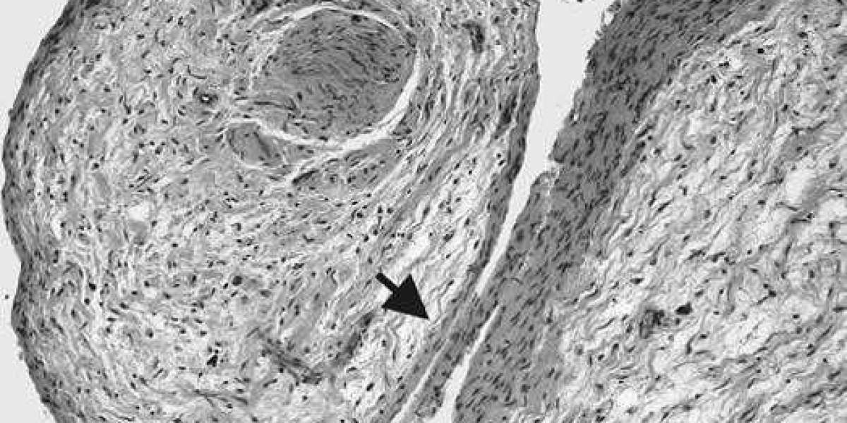 Emerging Innovations in the Treatment of Neurofibromatosis Type One-Associated Plexiform Neurofibromas: Market Insights 