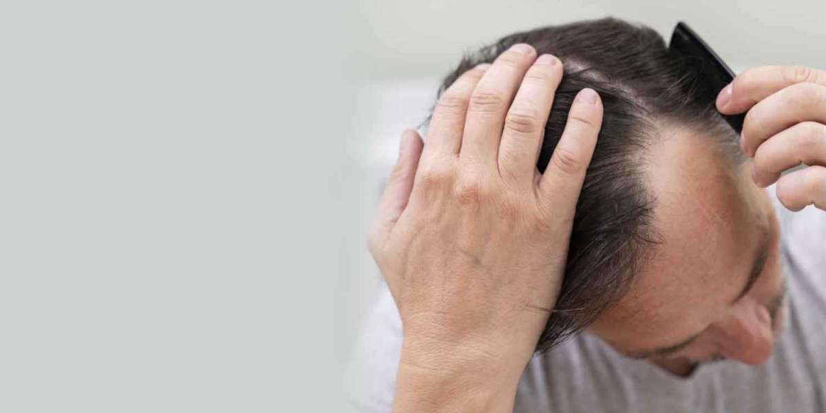 Before and After: How Hair Transplant Helped Me Regain My Confidence
