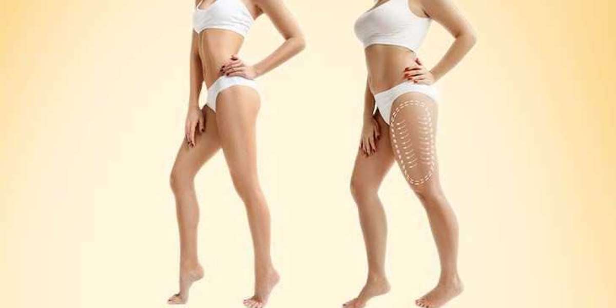 Best Liposuction Treatment in Dubai – Sculpt Your Body with Dr. Hans