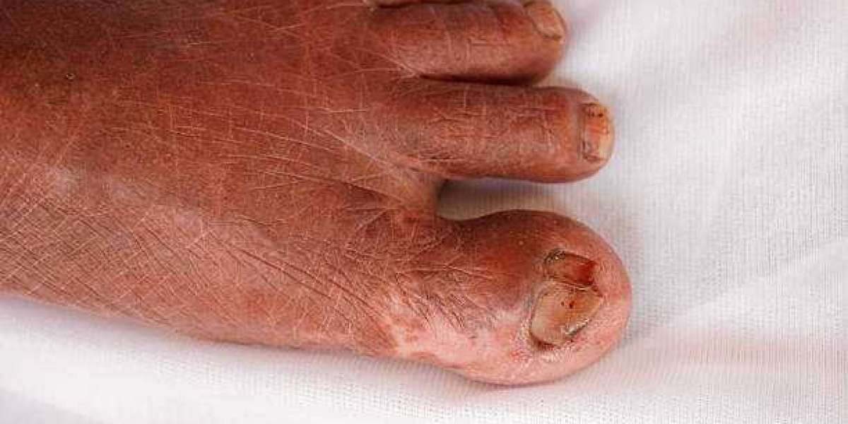 Dr. Vishal Patel Mumbai Vitiligo Treatment: Skilled Skin Repigmentation Care