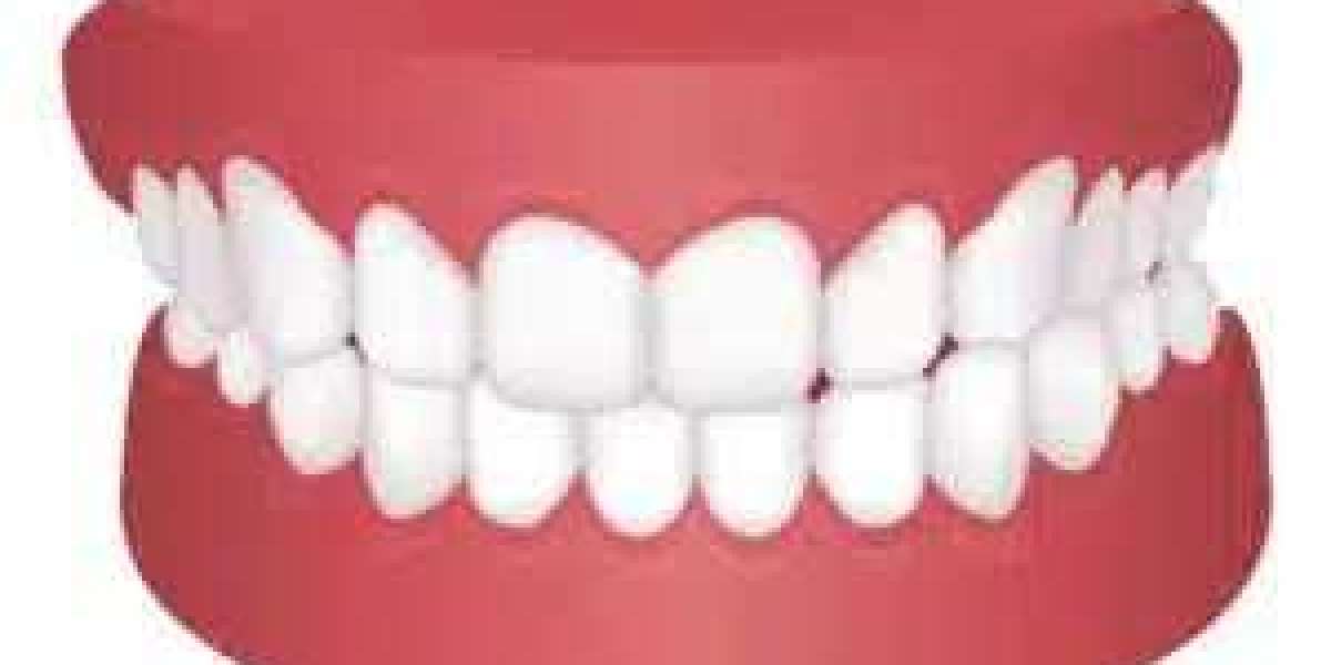 What Happens If You Don’t Wear Your Aligners Enough?