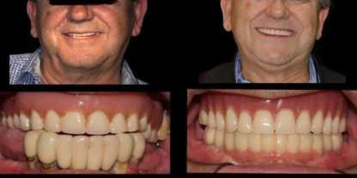 Estética Dental en Hospitalet de Llobregat Transforma tu Sonrisa