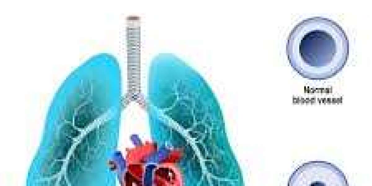 Understanding Pulmonary Hypertension