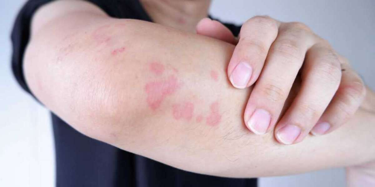 Unveiling the Future: Bacterial Skin Diseases Market Poised for Explosive Growth