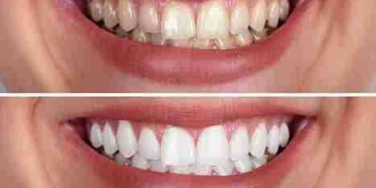 Why Your Lifestyle Could Be a Sabotaging Your Whitening Results