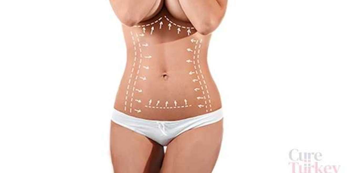 What are the Cost Benefits of Getting an Abdominoplasty in Turkey?