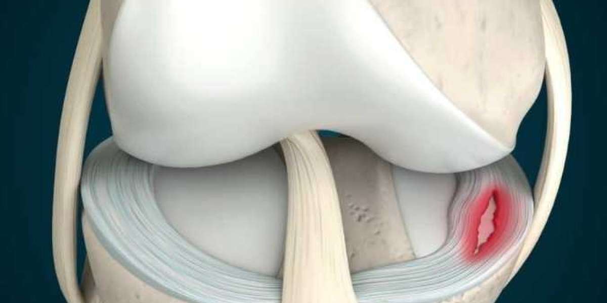 Best Meniscus Tear Treatment In Delhi NCR.
