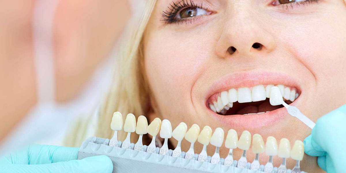 Benefits of Professional Teeth Whitening Treatment And Achieve A Stunning Smile