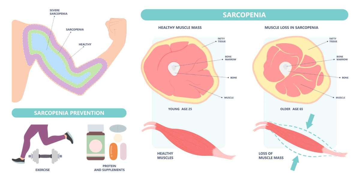 Addressing Age‑Related Muscle Loss: Sarcopenia Market Trends and Innovations