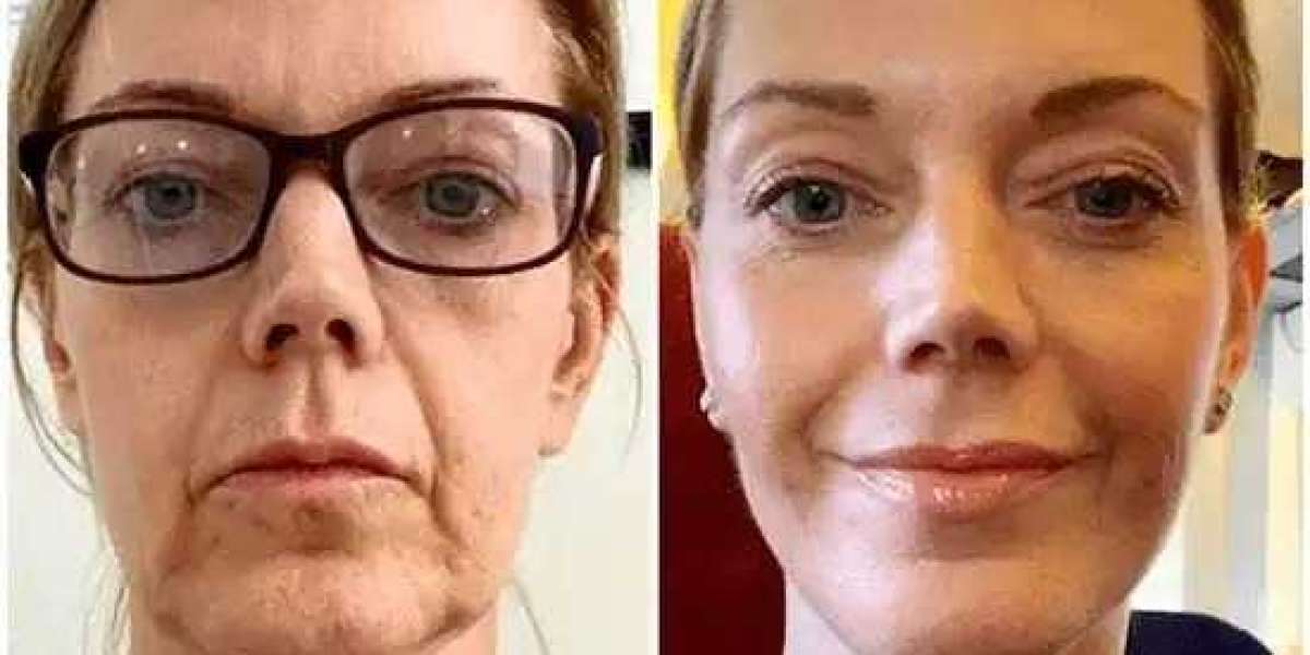 Ignite Youthful Radiance using Profhilo Treatment in Dubai with Profhilo