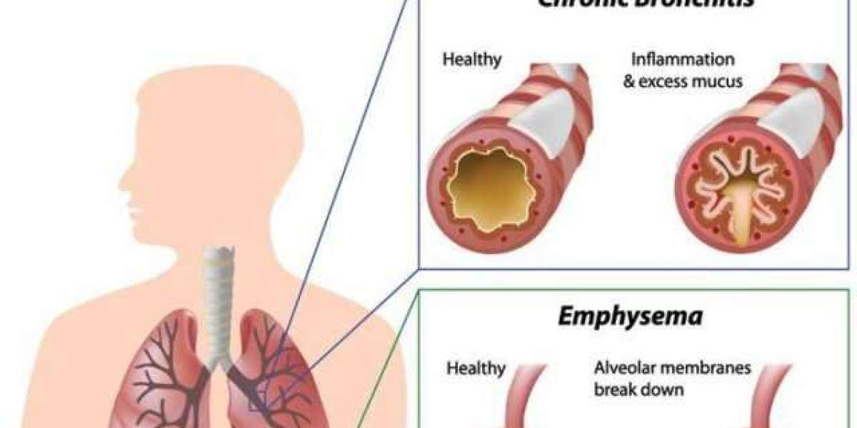 Nourishing Lung Health: Dr. J.K. Samaria’s Approach to COPD Care in Varanasi