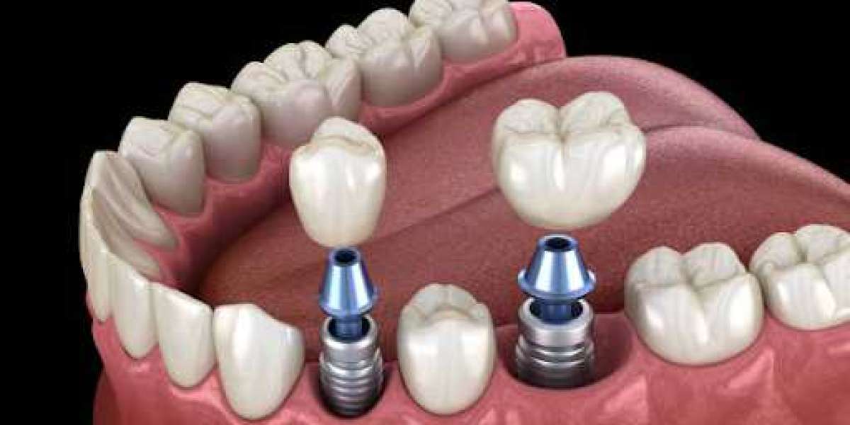 Urgent Dental Solutions for Tooth Extractions and Implants