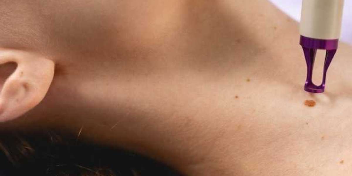 Skin Tag Removal At Clinic: Your Path To Clearer Skin
