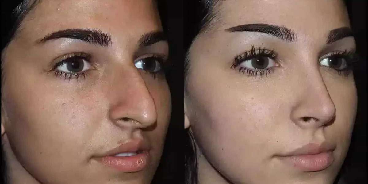 Best Time to Get Nose Deviated Septum Surgery in Dubai