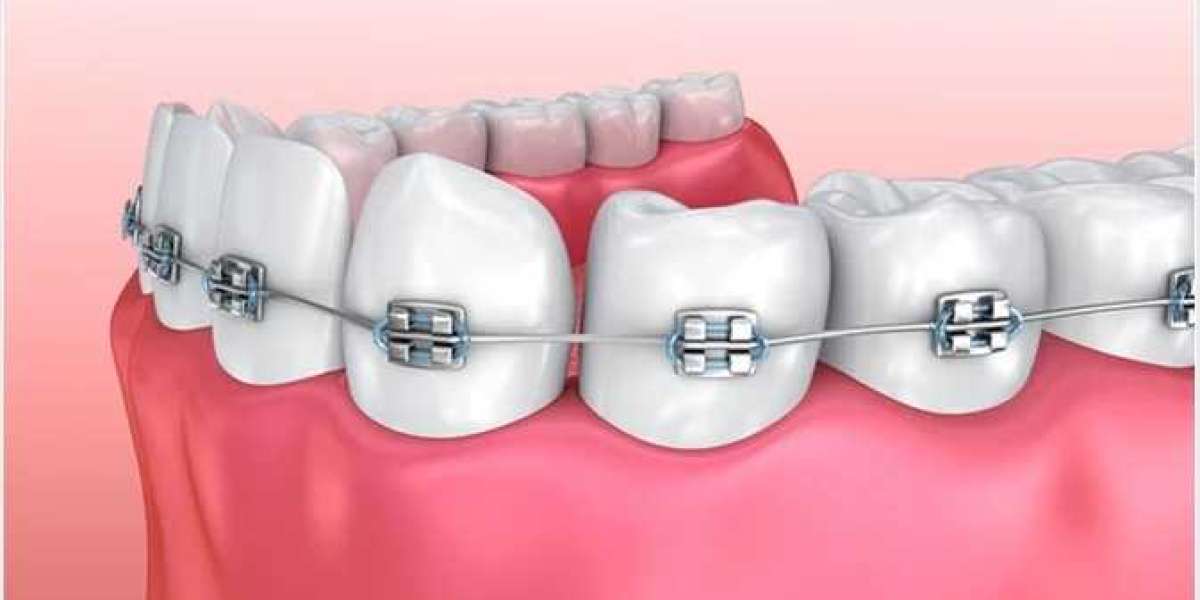 Cost-saving Tips for Braces Treatment