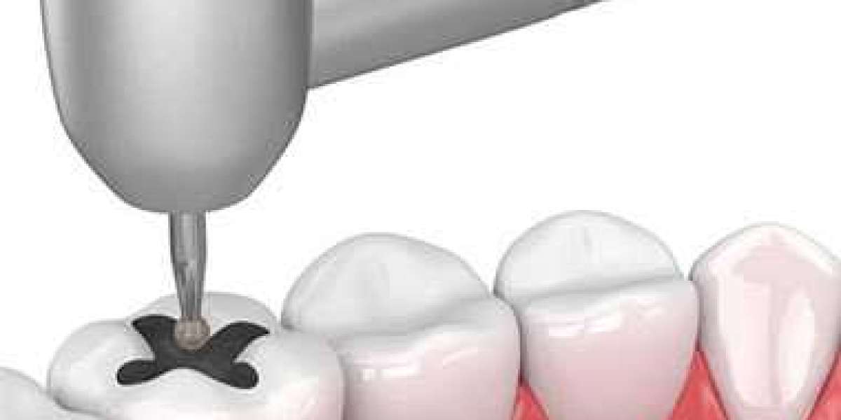Affordable Dentist Mt Roskill – Quality Tooth Extraction and Tooth Filling Services in Auckland