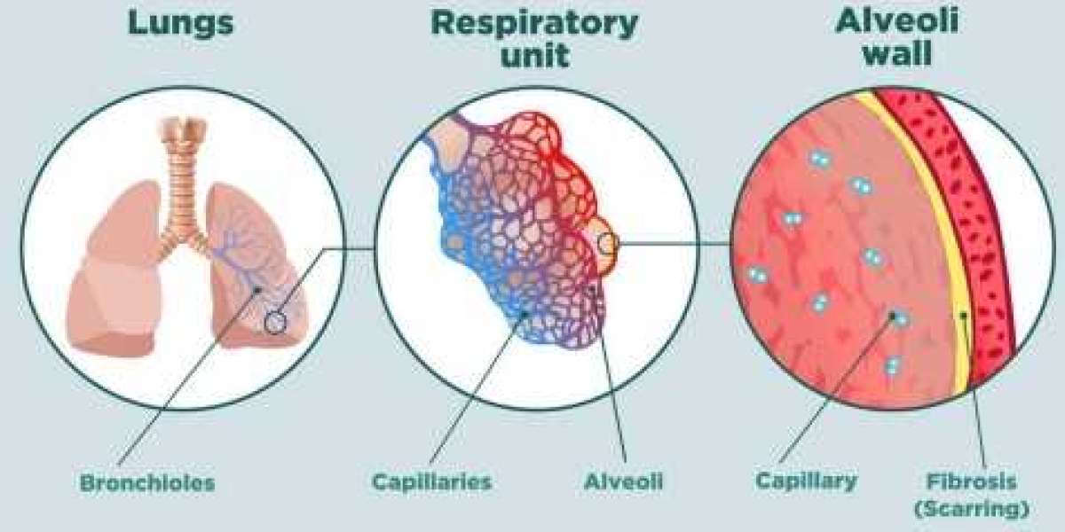 Mastering ILD Care in Varanasi: Dr. J.K. Samaria’s Path to Respiratory Wellness